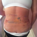 Back view, hunched over still.  You can see all the bruising from lipo.