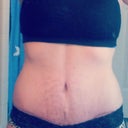 12 week post op