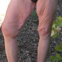 11 days to thigh lift! Baggy/Saggy be gone!!
