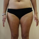 Before Lipo- Inner Thighs touch and rub