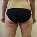 Before Lipo - Inner Thighs have a bulge