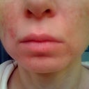 6 month and 21 day after ePrime (redness, brown spots, scars and noticeable wrinkles around the mouth, my face is shifting on left side)