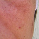 Over a year after the treatment the burnt mark is still there.