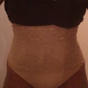 15 days post op - drains gone! I found a cute little spanx thong for $6 that I can wear now. On the hunt for more stage 2 garments..