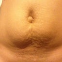 That ugly button bellybutton you see is my hernia. I am getting that and muscle repair. If I stand up a bit straighter you can see the center of my stomach has a large dent. Which I can't stand makes my stomach look weird. I never had this before pregnancy. The abdominal walls as well, are too separated due to a large almost 9lb baby.