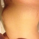 Right side stretch marks goodness there everywhere.  lol