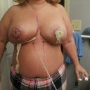 2 days post op... I feel like such an A cup!