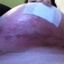 There is my infected boob about 2 hrs before it slpit open, you can kinda see the grren stuff thats were it came open and it all came out