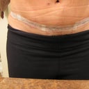 17 days post op
