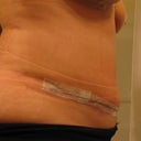 17 days post op