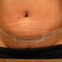 17 days post op