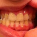 Hate my lighting; it makes me teeth look yellow when they are not that colour lol Here is an updated shot on my teeth with my bite closed. They still look pretty messed. I need to remind my Orthodontist to shave the bottoms of my top front teeth so they're not uneven.