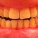 Bite open; looks worse in this picture than in person, but still pretty crooked and uneven.
