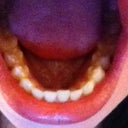 Bottom teeth; I do see a tiny bit of improvement, compared to the first picture I posted.