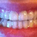 Tray #4 on my teeth