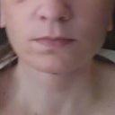 10 days PO - my nose is so swollen haha  Can't really tell here buy I'm still very swollen and look deformed.