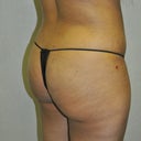 Side after 1 week, still swollen