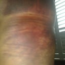 Left side 1 day post