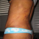 Left side 2 weeks post