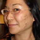 A few hours after my treatment