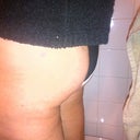 This is 10+ weeks and I feel back to normal.  Skin feels together and swelling long gone.  I think there is some flash in this picture but it was the bottom of the butt that was the very worst anyway.