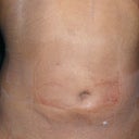 Front Less than 24hrs Day After Still Swollen 