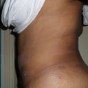 Side Less than 24hrs Day After Still Swollen 