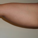 Arm before Vaser 