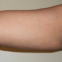 Arm Day 2 Still Swollen 