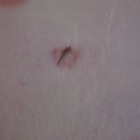 Slightly strange tummy button... not too bothered though. The whole thing looks a million times better than before! Those stretch marks used to be just under my boobs.