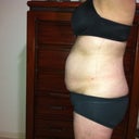 Pre Op side view ~ just as ugly