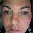 Immediately after, watch for the dots in my skin in the next pictures.