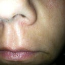 All of these taken about 2 hours after procedure.