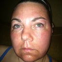 9 hours post procedure, becoming very edematous - swollen.