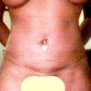 13 days after lipo. my stomach is now beginning to smooth and even out pretty nicely as u can see