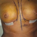 morning after surgery