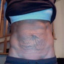 pre surgery