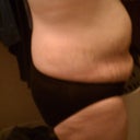 Day 11- so swollen! This picture has been posted to ease other peoples' minds that- yes it's true- you do swell up like no other during the recovery.