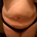 Day 11- so swollen! This picture has been posted to ease other peoples' minds that- yes it's true- you do swell up like no other during the recovery.