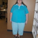 This is my initial photo taken a month prior to surgery at the center.