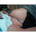 Day 2 (dr had to fix the scars from previous breast reduction)