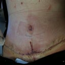 post op day 3.