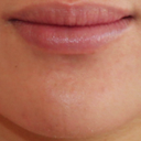 Lip Implant