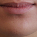 Lip Implant