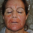 1 hour post laser. I will keep updating pics. I will also do a before/after when I'm healed