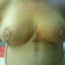 4 days post-op