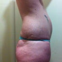 pre op side view