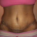 Tape was removed from incision. Spot on the left is where my last drain was removed. The hole from the first drain has already closed. My PS lined the drain holes up w/ my incision. In his words....so I don't end up with 2 little eyes in my pubic area.