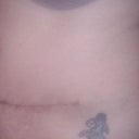 12 weeks 1 day My Hourglass is coming back nicely and I have a few bumps from the underlying stitches but it will get better