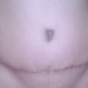 My scar is not going away as fast as most of yours but I know it will I just stopped looking at the scar for a while now.